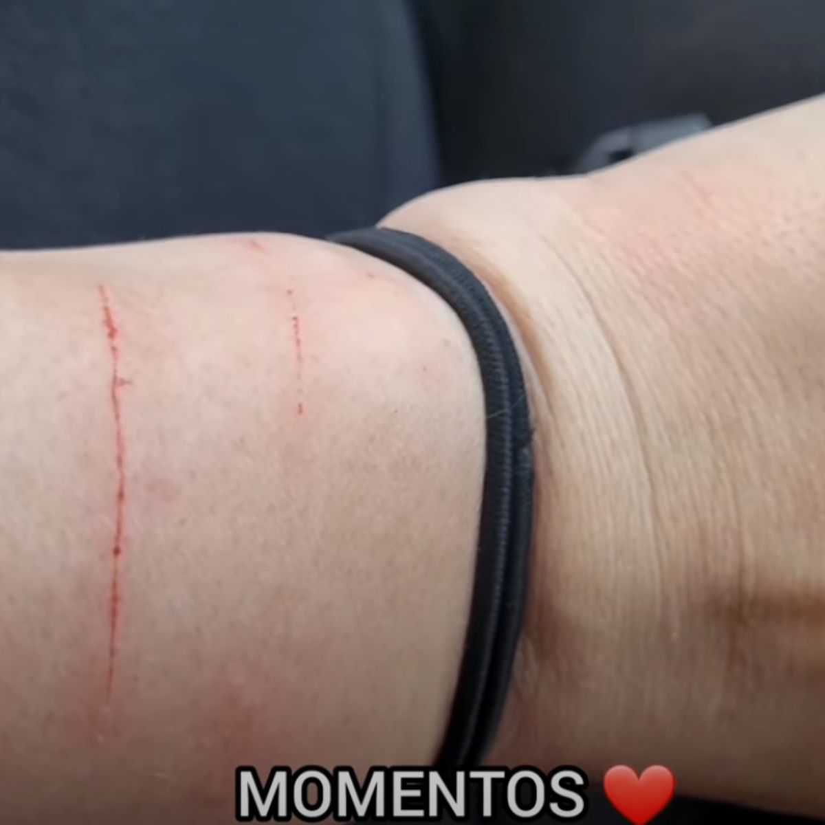 scratch marks on hand